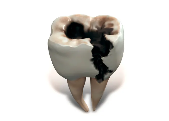 tooth decay illustration